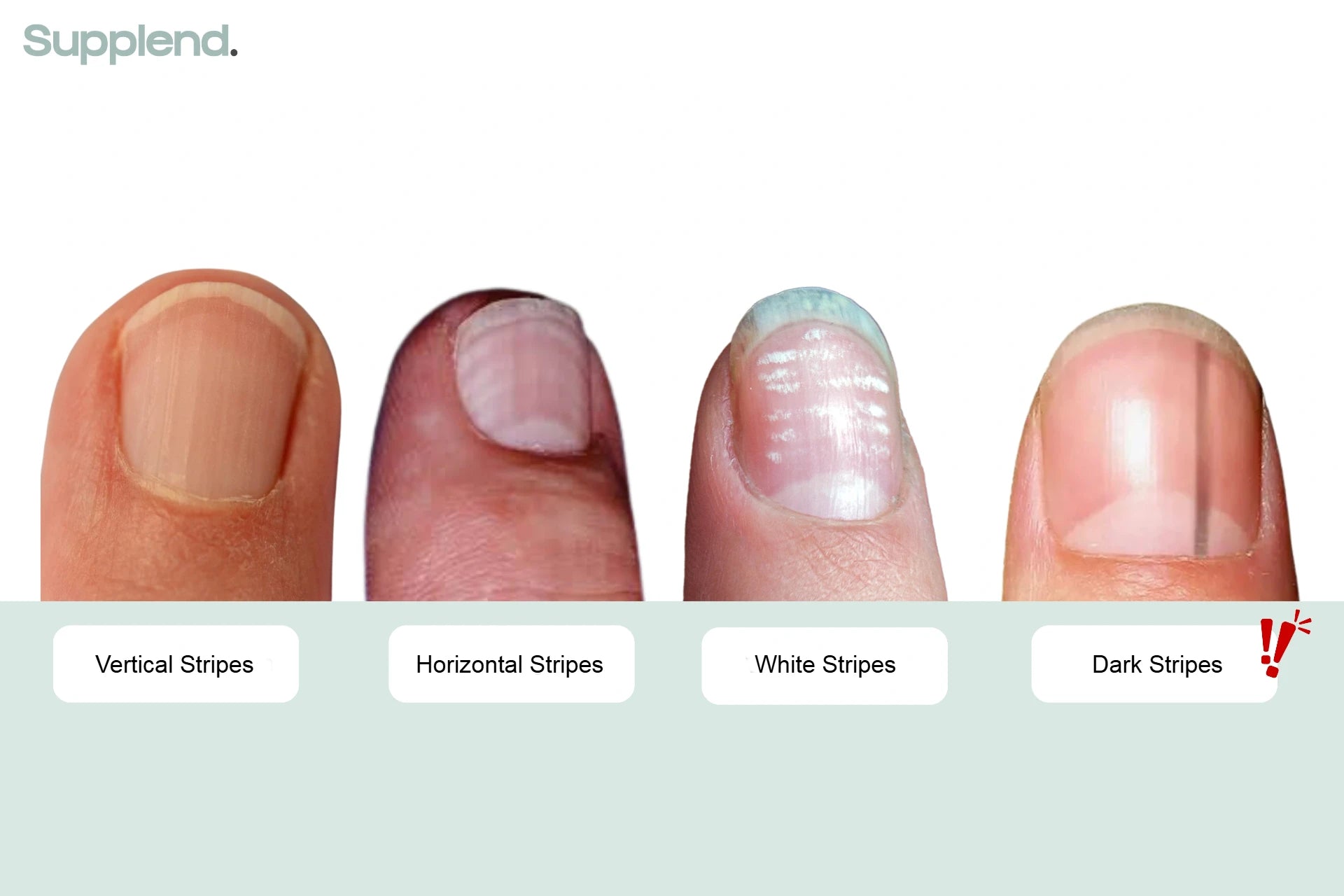 Image showing different types of stripes on nails. Compare the difference of vertical stripes on nails, horizontal stripes, white stripes on nails and dark stripes on nails.